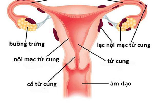 Lạc nội mạc tử cung trong cơ tử cung (Bệnh tuyến cơ tử cung)