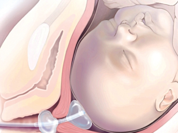 Các phương pháp gây khởi phát chuyển dạ